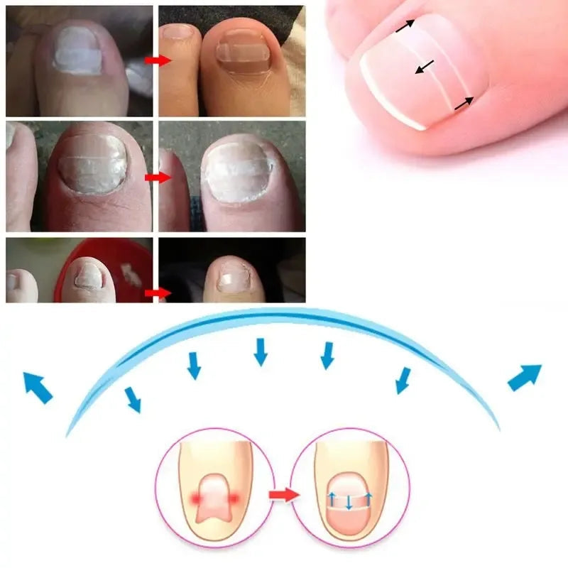 10pcs Ingrown Toenail Correction Clips