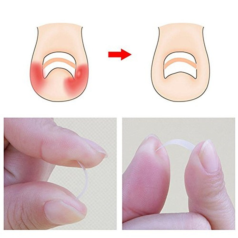 10pcs Ingrown Toenail Correction Clips