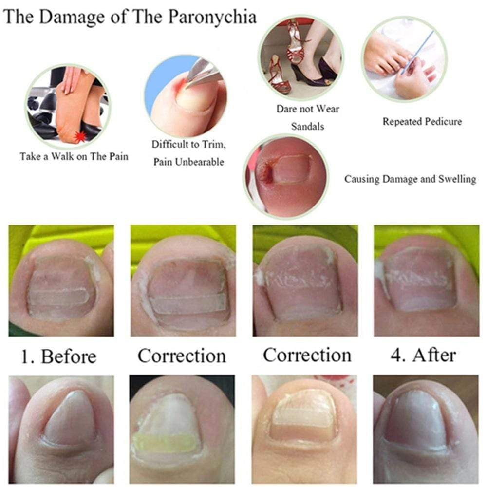 10pcs Ingrown Toenail Correction Clips