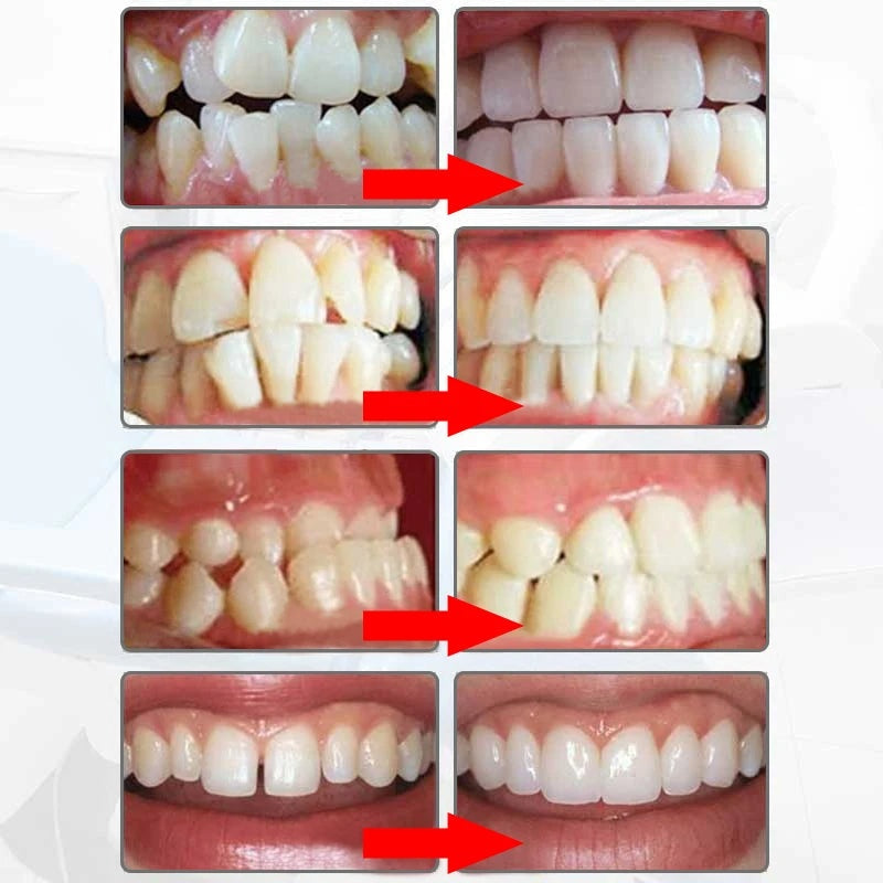 Adult Orthodontic Teeth Straightener for Alignment and Grinding