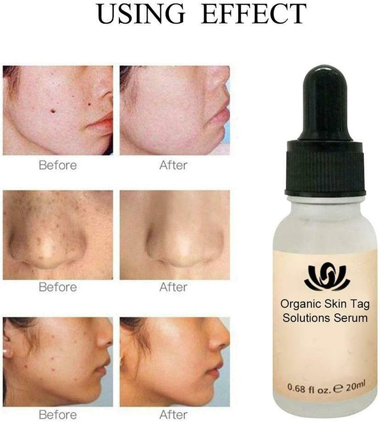 All-Natural Skin Tag and Mole Removal Serum, Herbal Formula