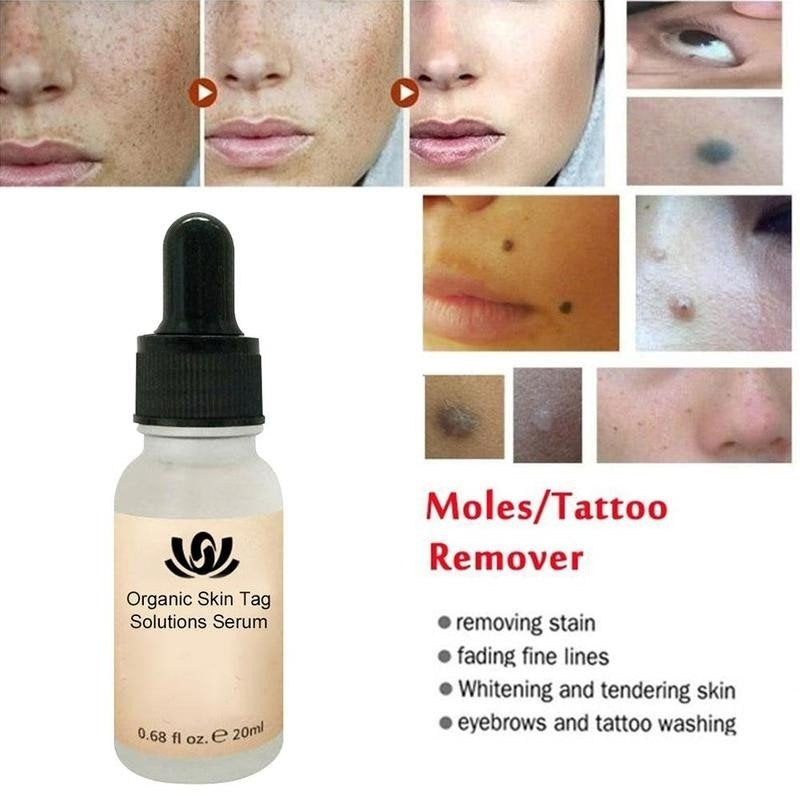 All-Natural Skin Tag and Mole Removal Serum, Herbal Formula