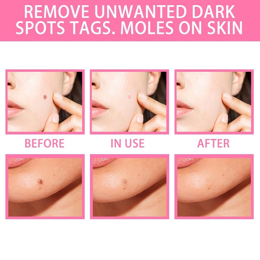 All-Natural Skin Tag and Mole Removal Serum, Herbal Formula