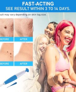 Skin Tag Removal Kit