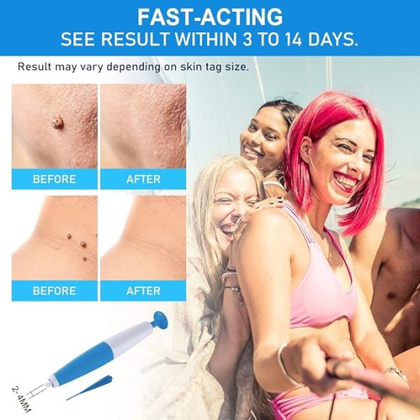 Skin Tag Removal Kit