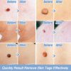 Skin Tag Removal Kit