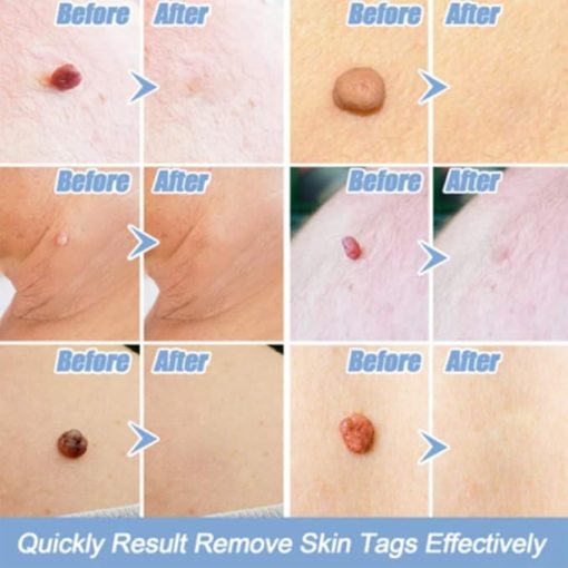 Skin Tag Removal Kit