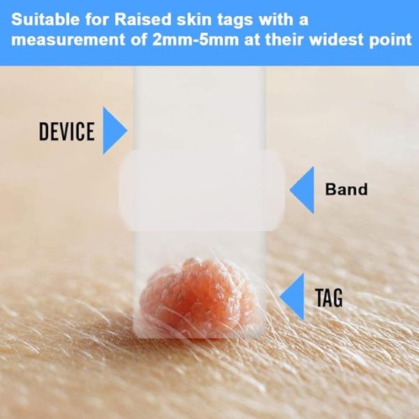 Skin Tag Removal Kit