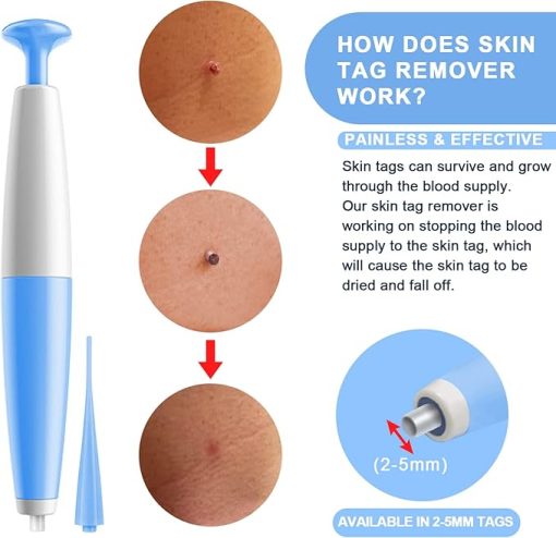 Skin Tag Removal Kit