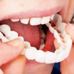 Adjustable Snap On Dentures – Smile Veneers – Doctors Recommended