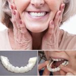 Snap On Smile Veneers (Upper & Lower Included)